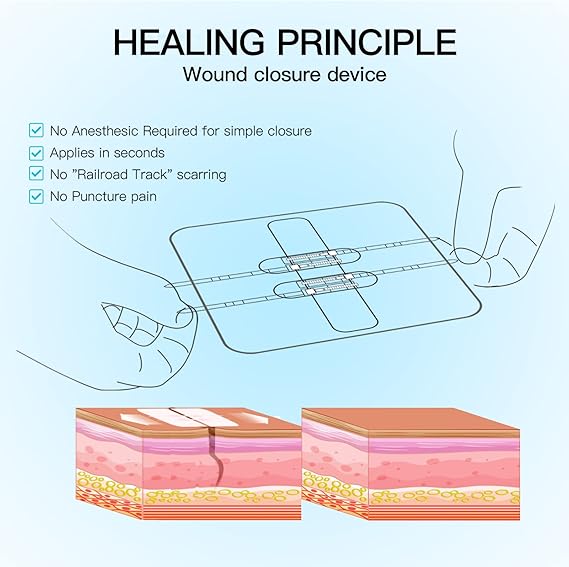 Zip Stitch Laceration Repair Without Stitches